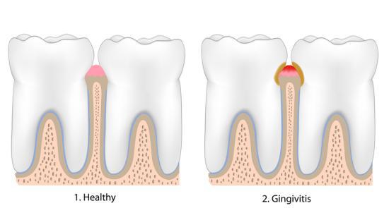 Home remedies for Gingivitis